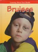 Bruises cover