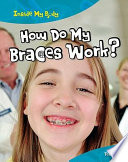 How Do My Braces Work? Teeth cover